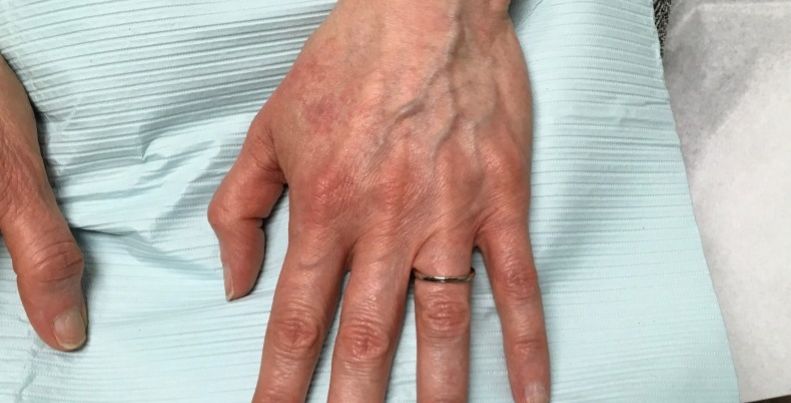 before hand filler top view case 2