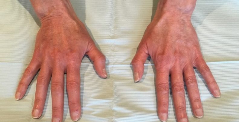 after hand filler top view both hands case 2