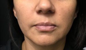 after facial & neck front filler female patient front view case 10