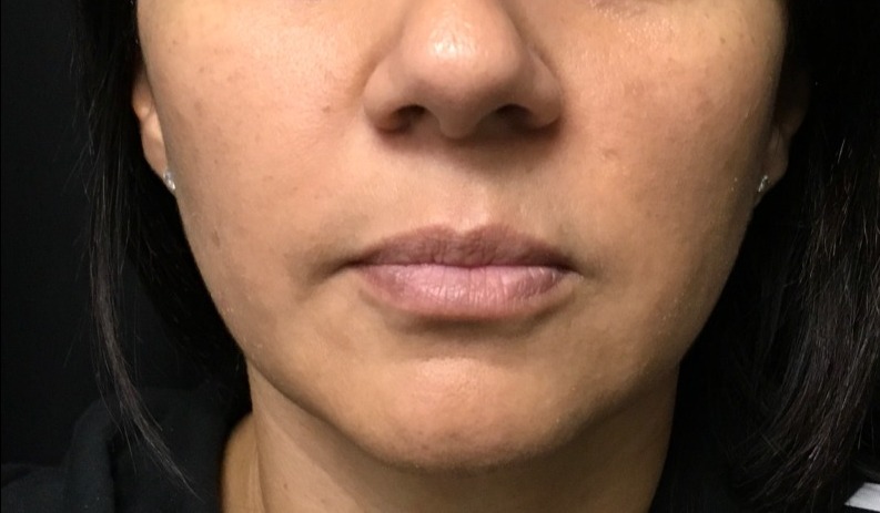 after facial & neck front filler female patient front view case 10