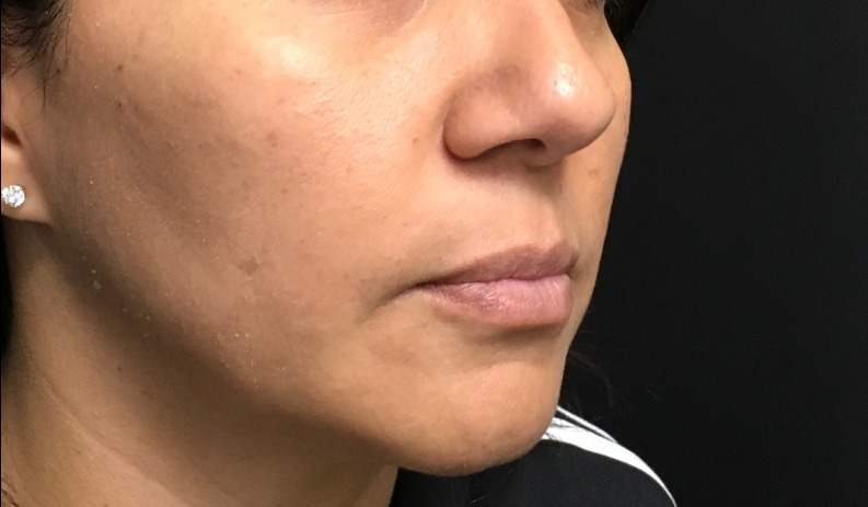 after facial & neck filler female patient front view case 10 2