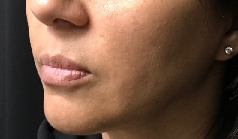 after facial & neck filler female patient front view case 10