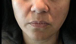before facial & neck filler front female patient front view case 10