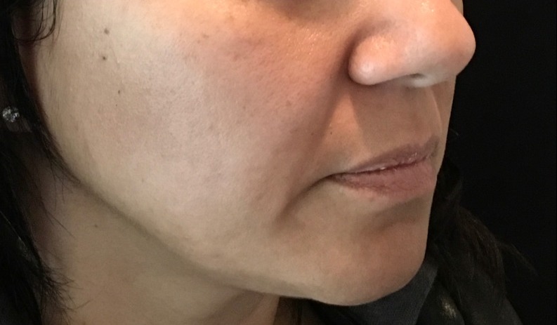 before facial & neck filler female patient front view case 10 2