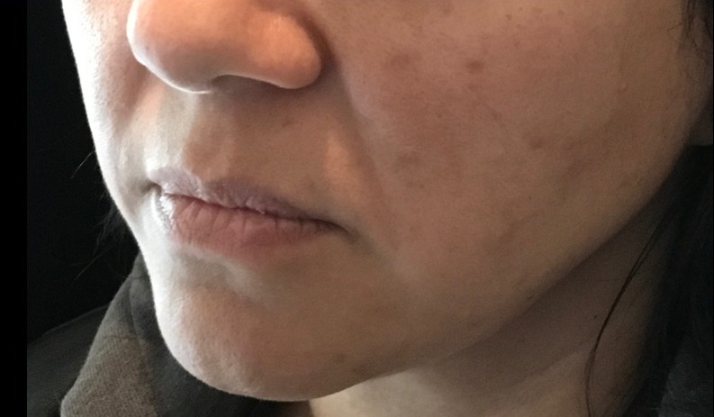 before facial & neck filler female patient front view case 10