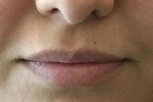 Before facial filler lips female patient front view case 17