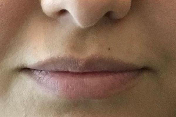 Before facial filler lips female patient front view case 17