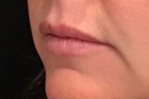 before lip filler female patient left angle view case 16