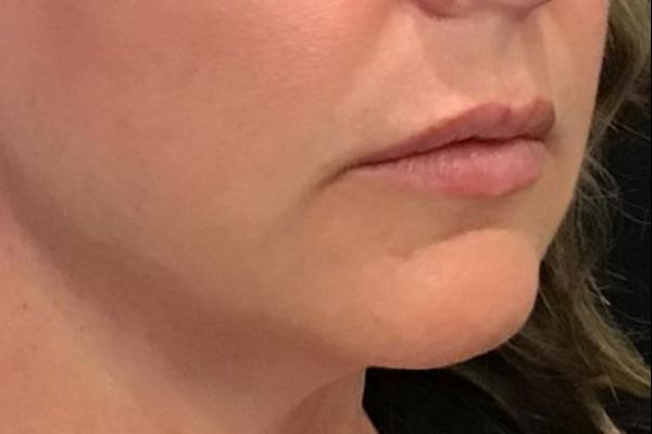 before facial filler lips female patient angle view case 16