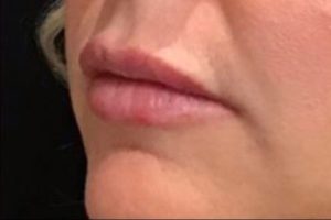 after lip filler female patient left angle view case 16