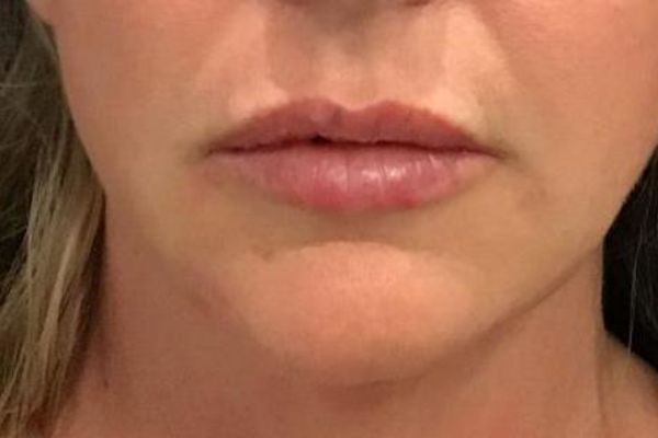after facial filler lips female patient front view case 16