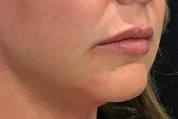 after facial filler lips female patient angle view case 16