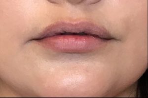 before lip filler female patient front view case 15