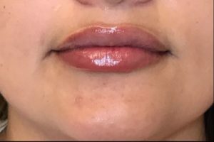 after lip filler female patient front view case 15