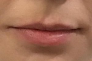 before lip filler female patient front view case 14