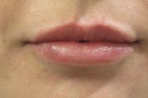 after lip filler female patient front view case 14