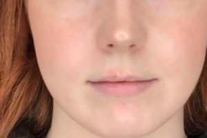 before lip filler female patient front view case 13