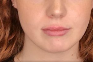after lip filler female patient front view case 13