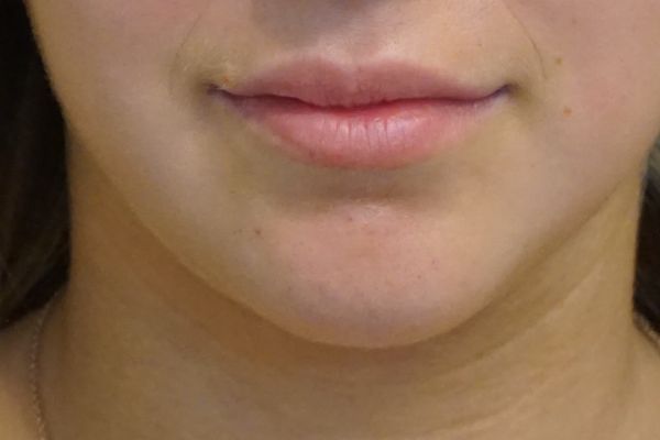 before lip filler female patient front view case 12