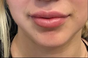 after lip filler female patient front view case 12