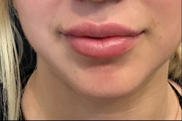 after lip filler female patient front view case 12
