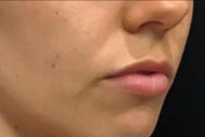 before lip filler female patient right angle view case 11