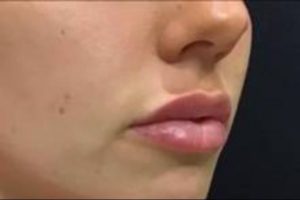 after lip filler female patient right angle view case 11