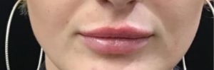 after lip filler female patient front view case 10