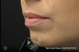 before lip filler female patient left angle view case 9