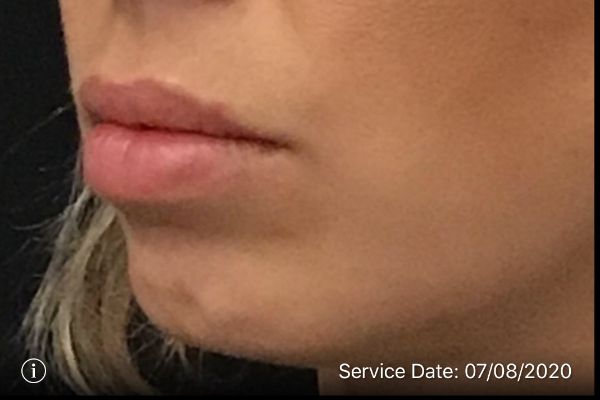 after lip filler female patient left angle view case 9