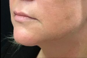 before lip filler female patient left angle view case 8