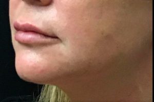 after lip filler female patient left angle view case 8
