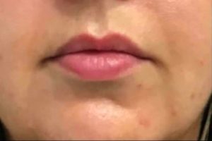 before lip filler female patient front view case 7