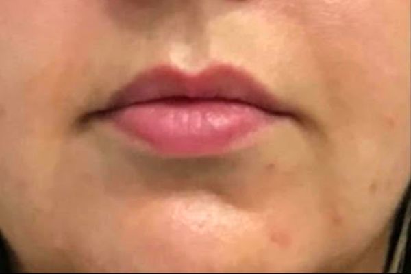 before lip filler female patient front view case 7