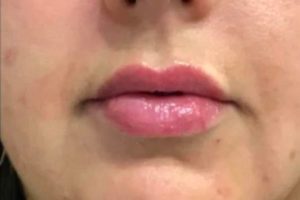 after lip filler female patient front view case 7
