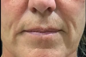 before lip filler female patient front view case 6
