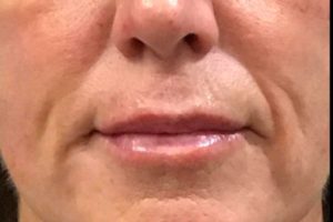 after lip filler female patient front view case 6
