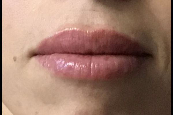 after lip filler female patient front view case 5