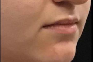 before lip filler female patient right angle view case 4