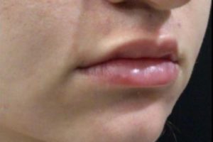 after lip filler female patient right angle view case 4