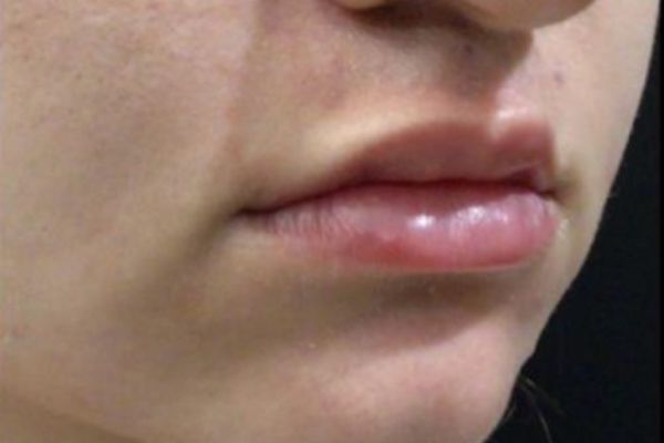 after lip filler female patient right angle view case 4