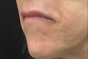before lip filler female patient left angle view case 3
