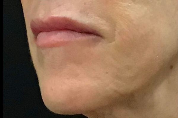 after lip filler female patient left angle view case 3