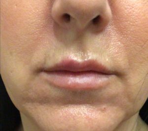 after lip filler female patient front view case 2