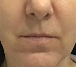 before lip filler female patient front view case 2
