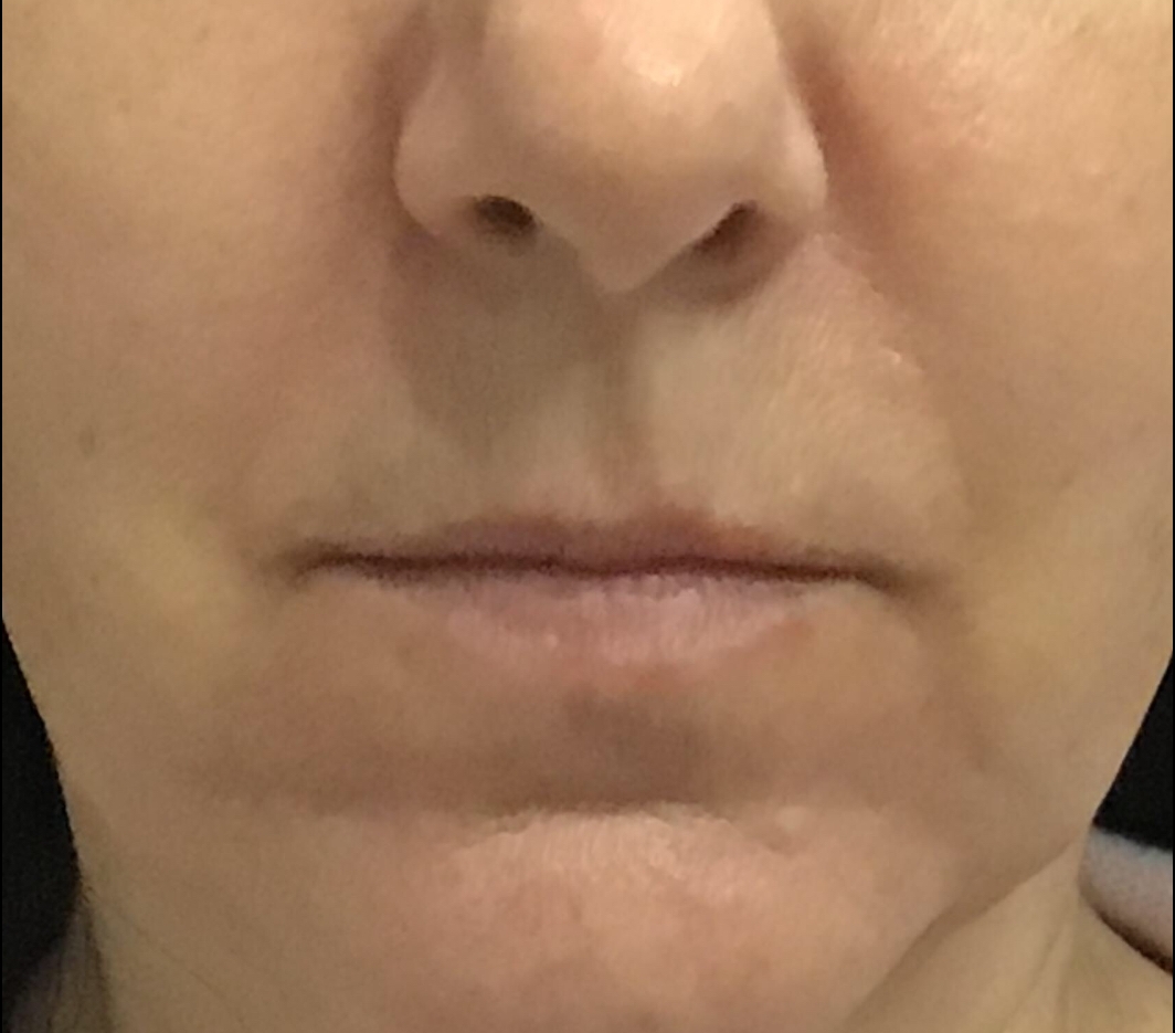 before lip filler female patient front view case 2