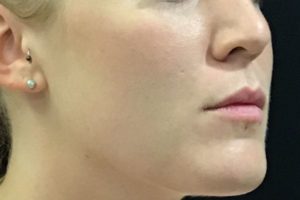 before lip filler female patient right angle view case 1