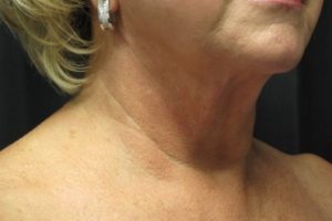 after j-plasma skin tightening neck female patient right angle case 10
