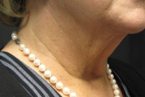 before j-plasma skin tightening neck female patient right angle case 10