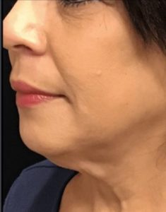 before j-plasma skin tightening face angle female patient case 2